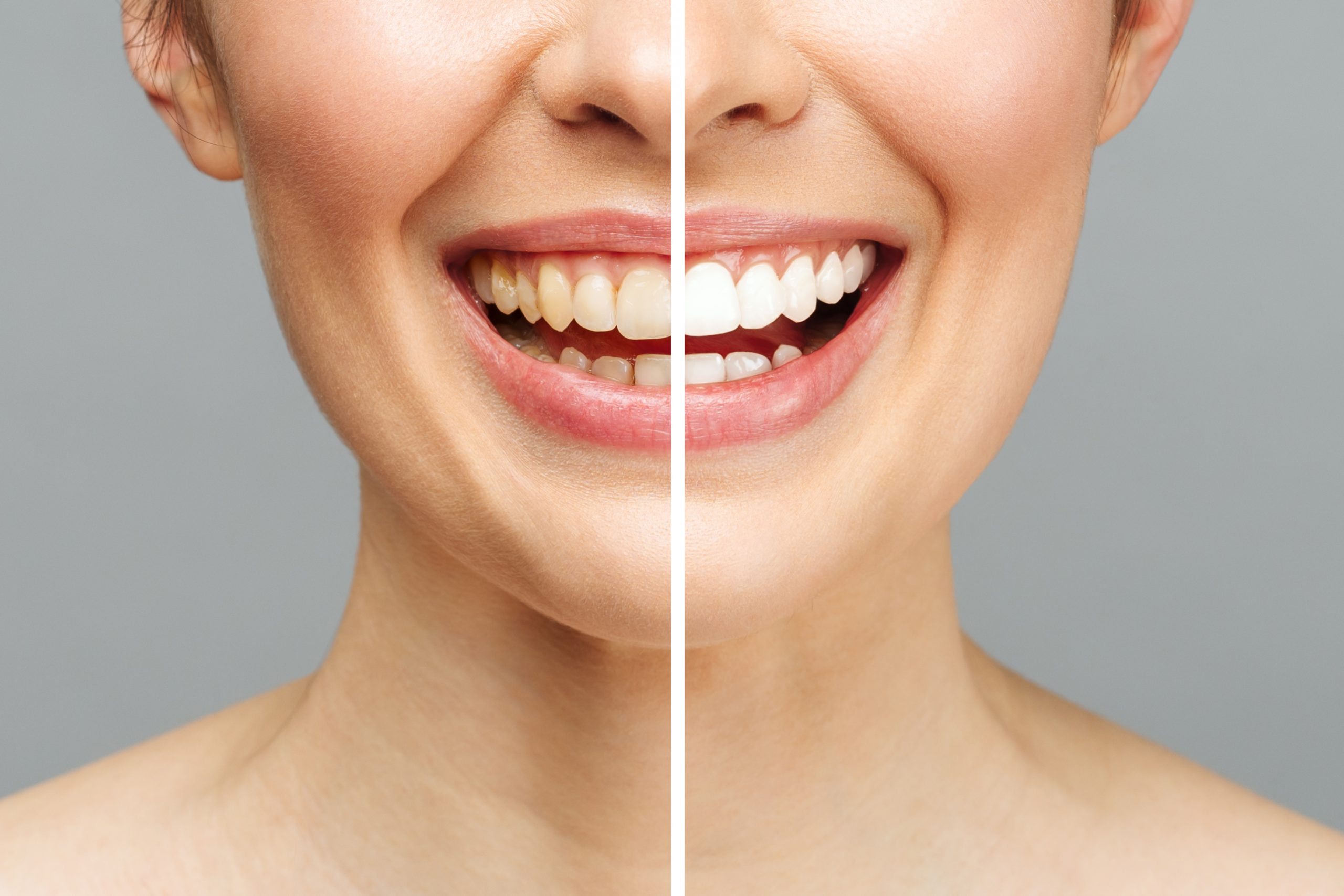 Before and After Teeth Whitening