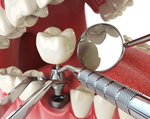 dental implants