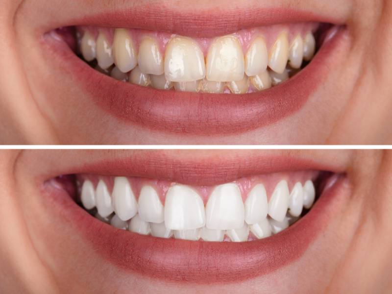 Everything You Need to Know about Teeth Whitening