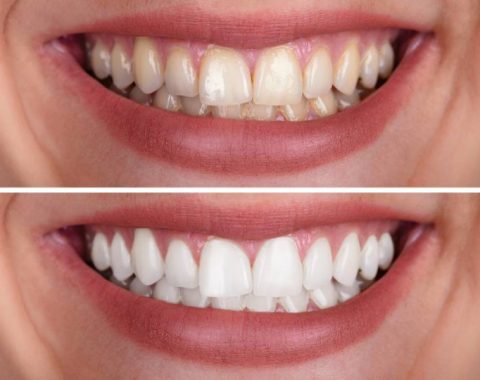 teeth whitening example