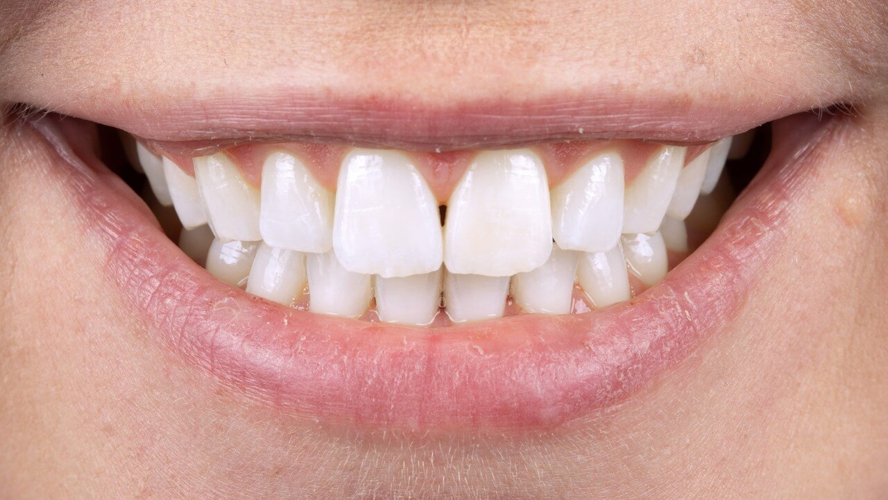 Dental Care After