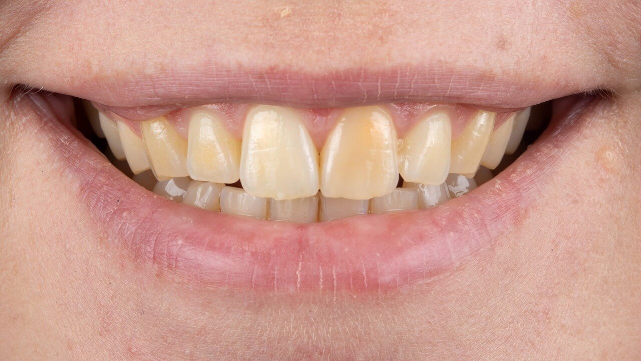 Dental Care Before